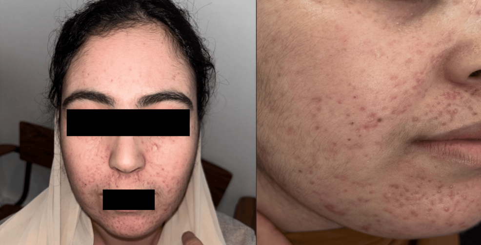 Photo: Cureus Lupus Miliaris Disseminatus Faciei: A Complex Facial Diagnostic Challenge