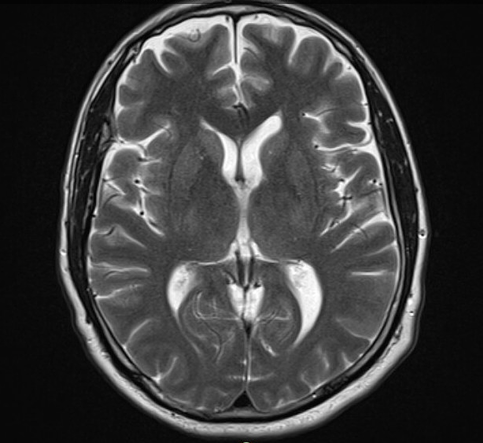 A Unique Case of Bannwarth Syndrome in Early Disseminated Lyme Disease ...