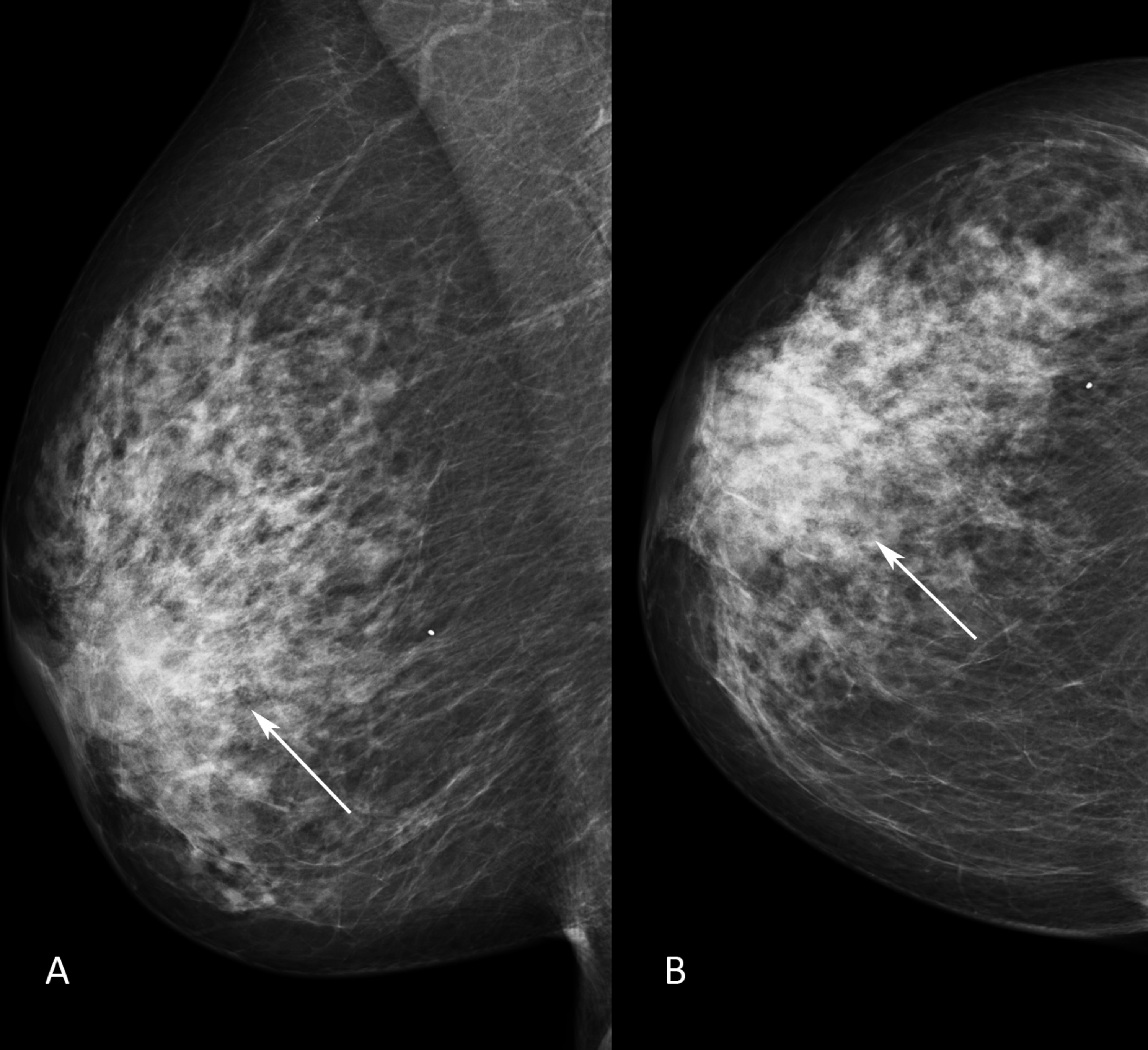 Cureus | MRI Diagnosis of Needle Tract Tumor Seeding Following Core ...