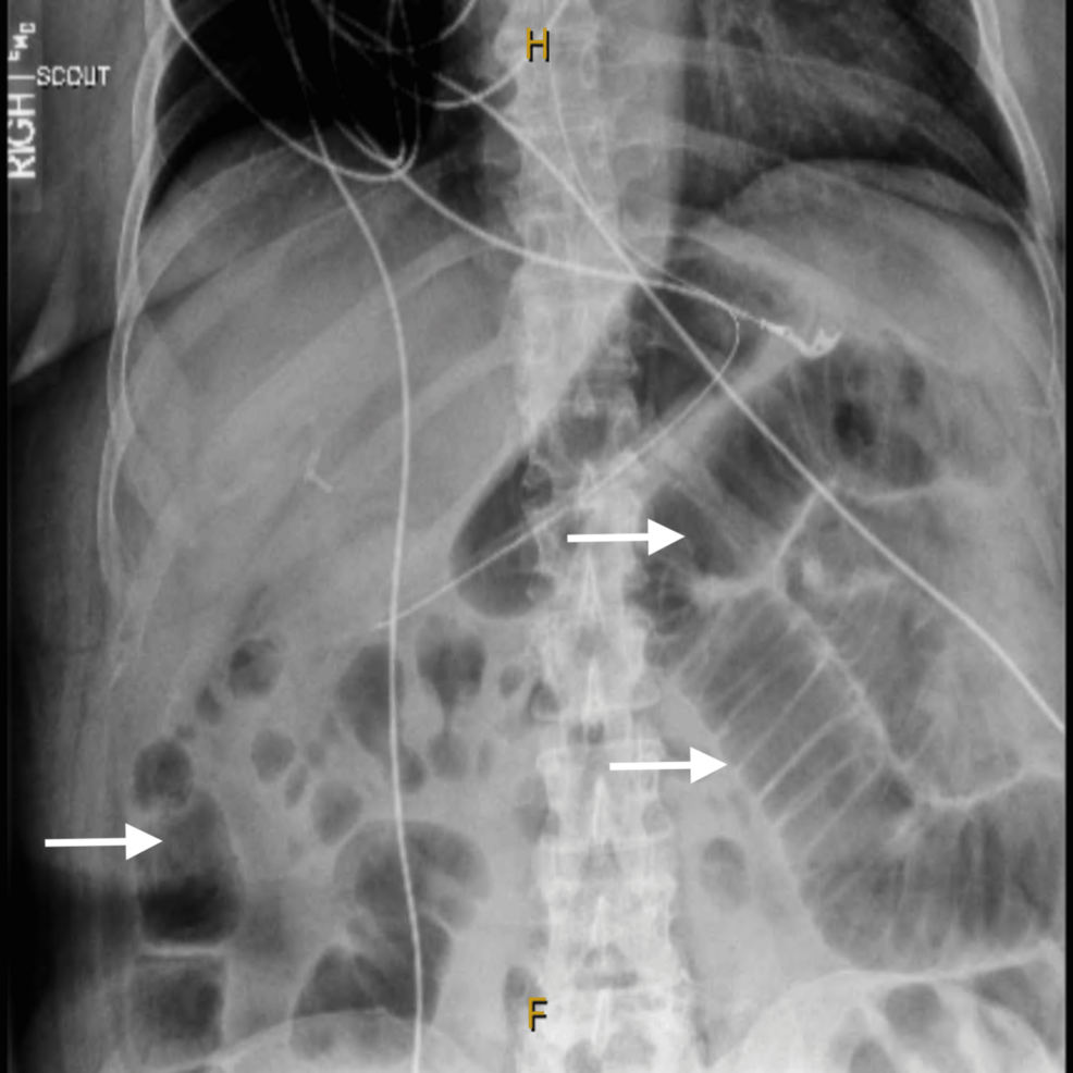 semaglutide and bowel obstruction Acute Small Bowel Obstruction Induced by Tirzepatide (Mounjaro)