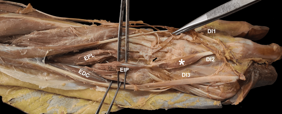 Anomalous Extensor Indicis With an Intermediate Tendon: Surgical and Functional Management - News Directory 3