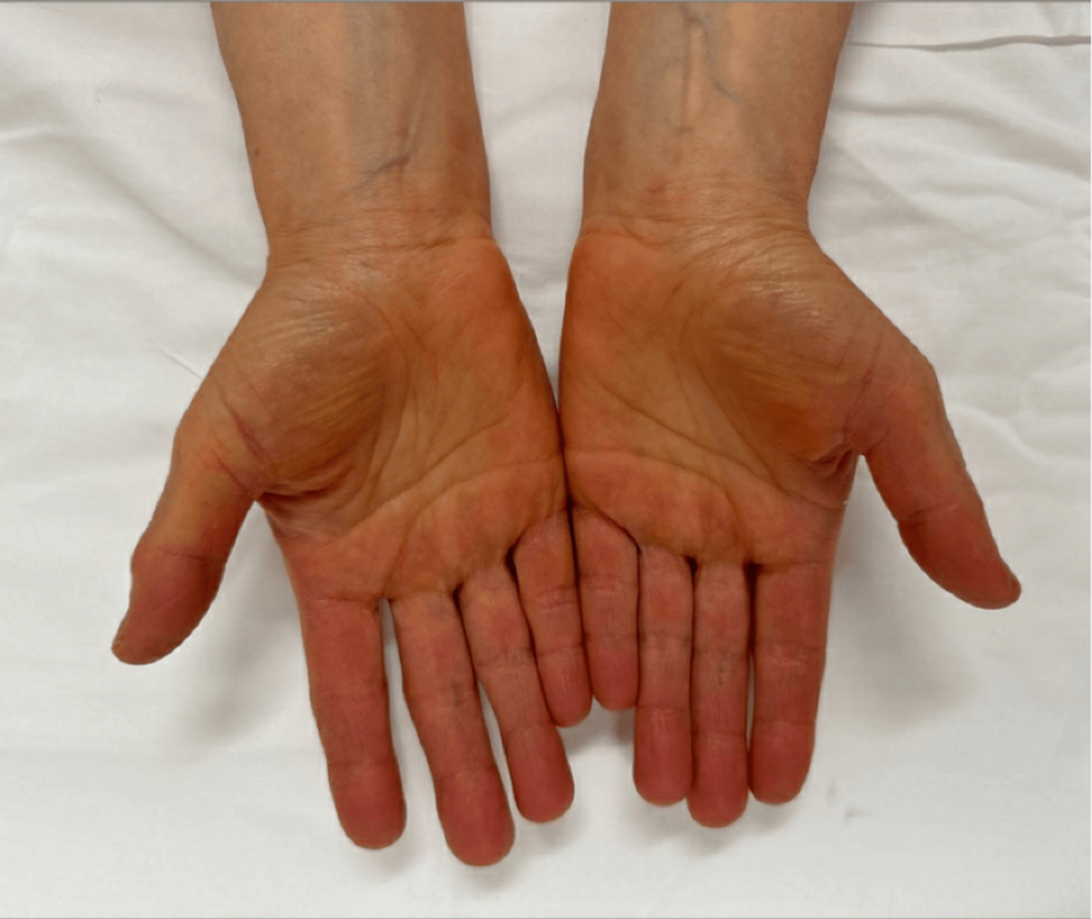 Yellow-orange-discoloration-of-the-bilateral-palms
