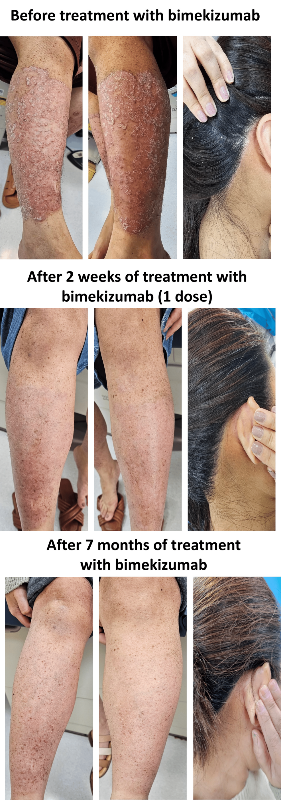 Bimekizumab for Hard-to-Treat Psoriasis: Two Successful Case Studies - News Directory 3