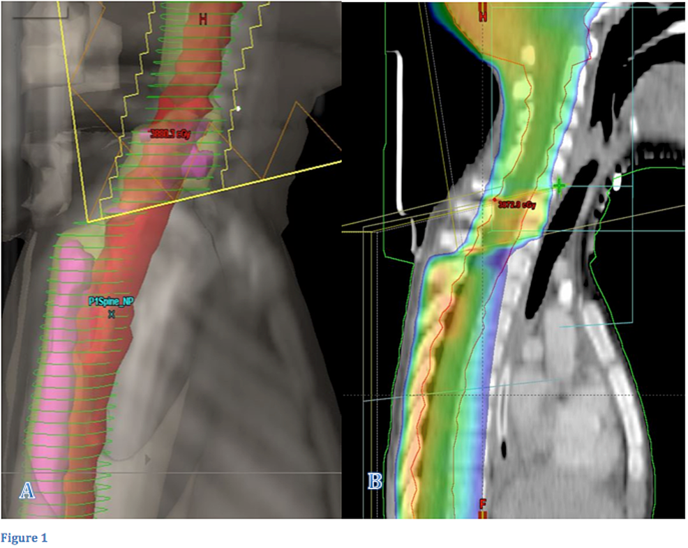 FieldinField Technique With Intrafractionally Modulated Junction