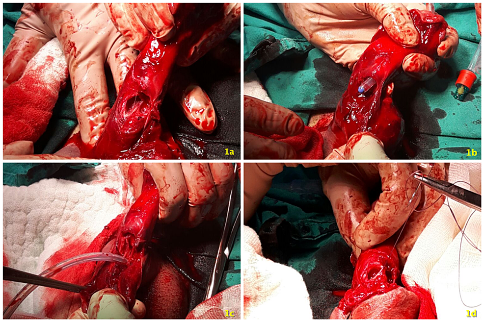 a and b. Preoperative appearance of the buried penis. c and d Lateral