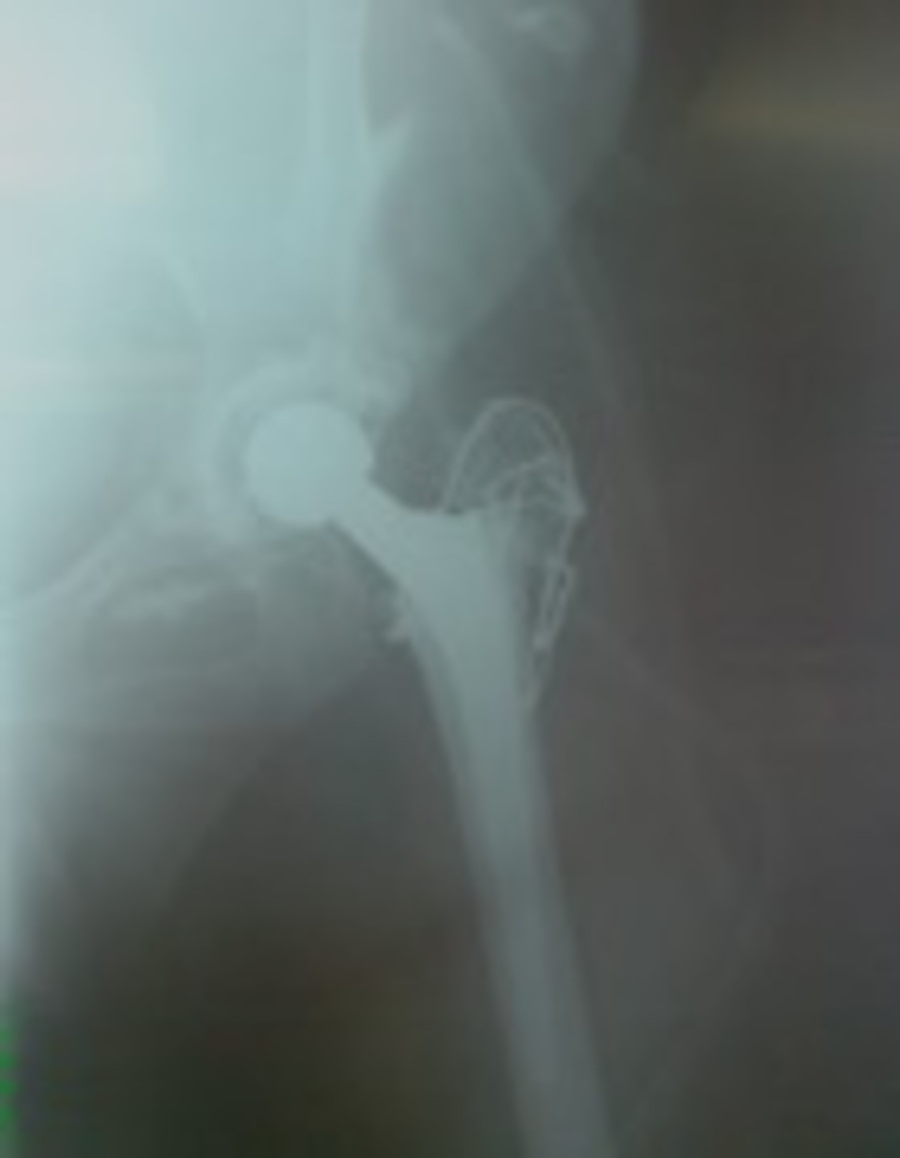 Cureus Total Hip Replacement in Developmental Hip Dysplasia A