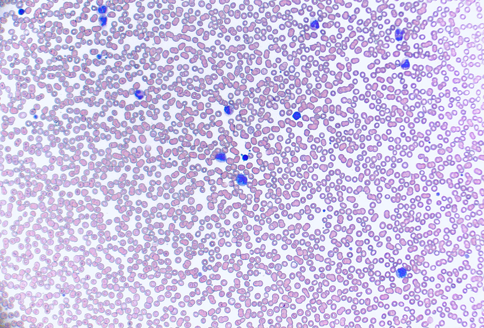 Initial-peripheral-smear-demonstrating-no-visible-platelets