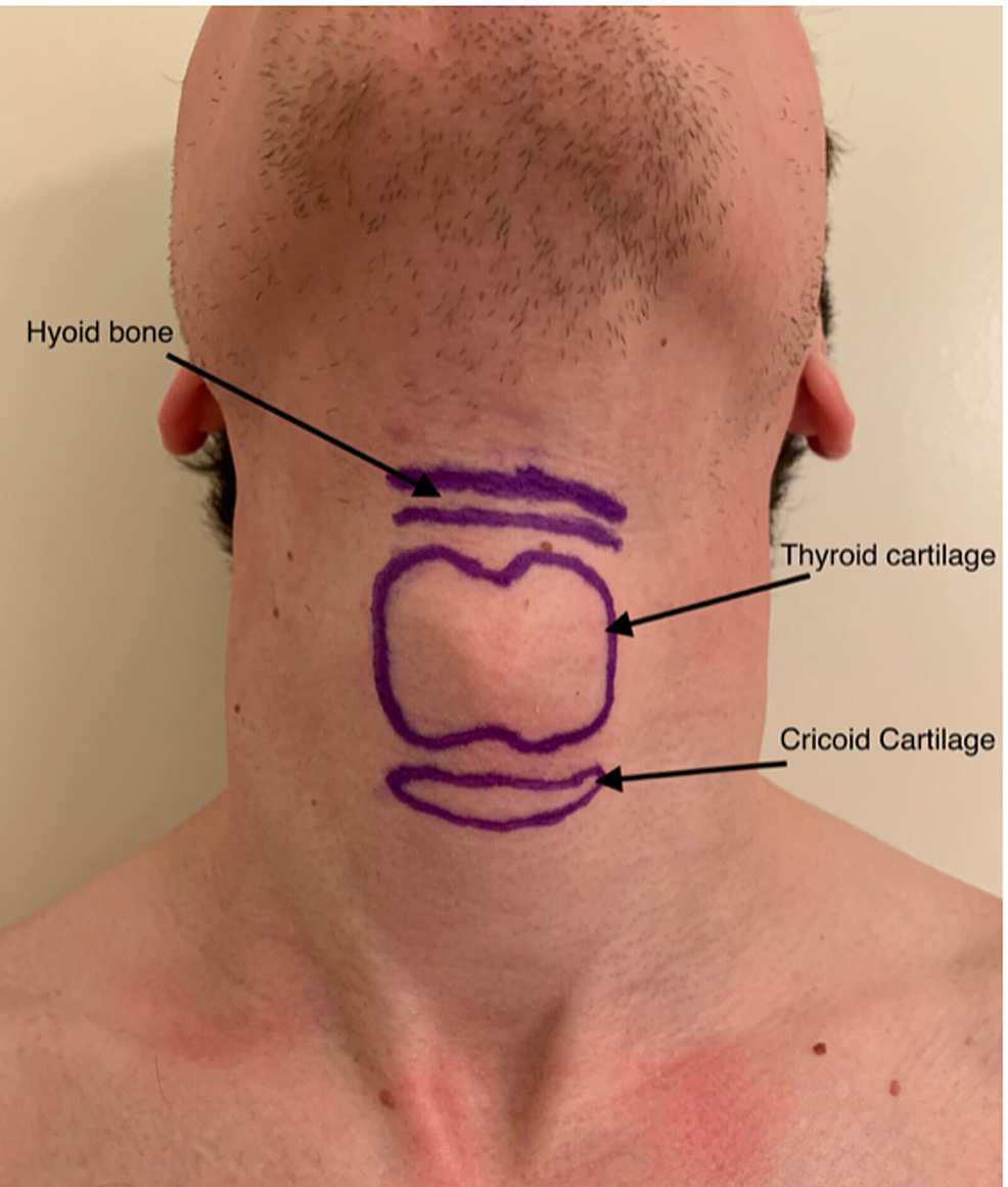 Cureus Airway Anesthesia for Awake Tracheal Intubation A Review of