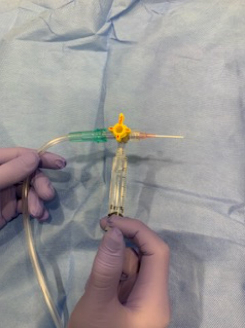 Cureus Airway Anesthesia for Awake Tracheal Intubation A Review of