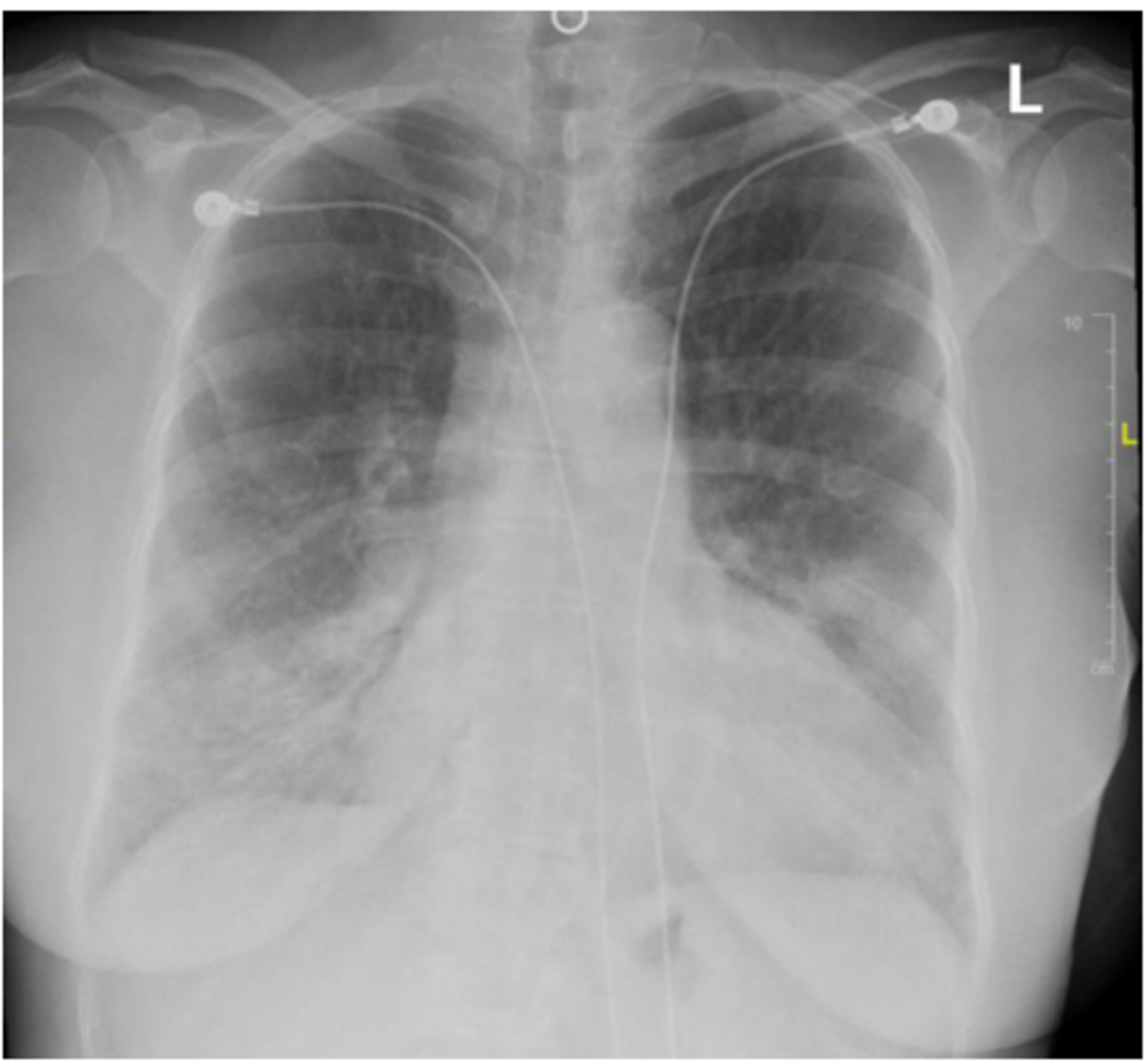 Cureus | A Rare Case of SARS-CoV-2-Induced Microscopic Polyangiitis