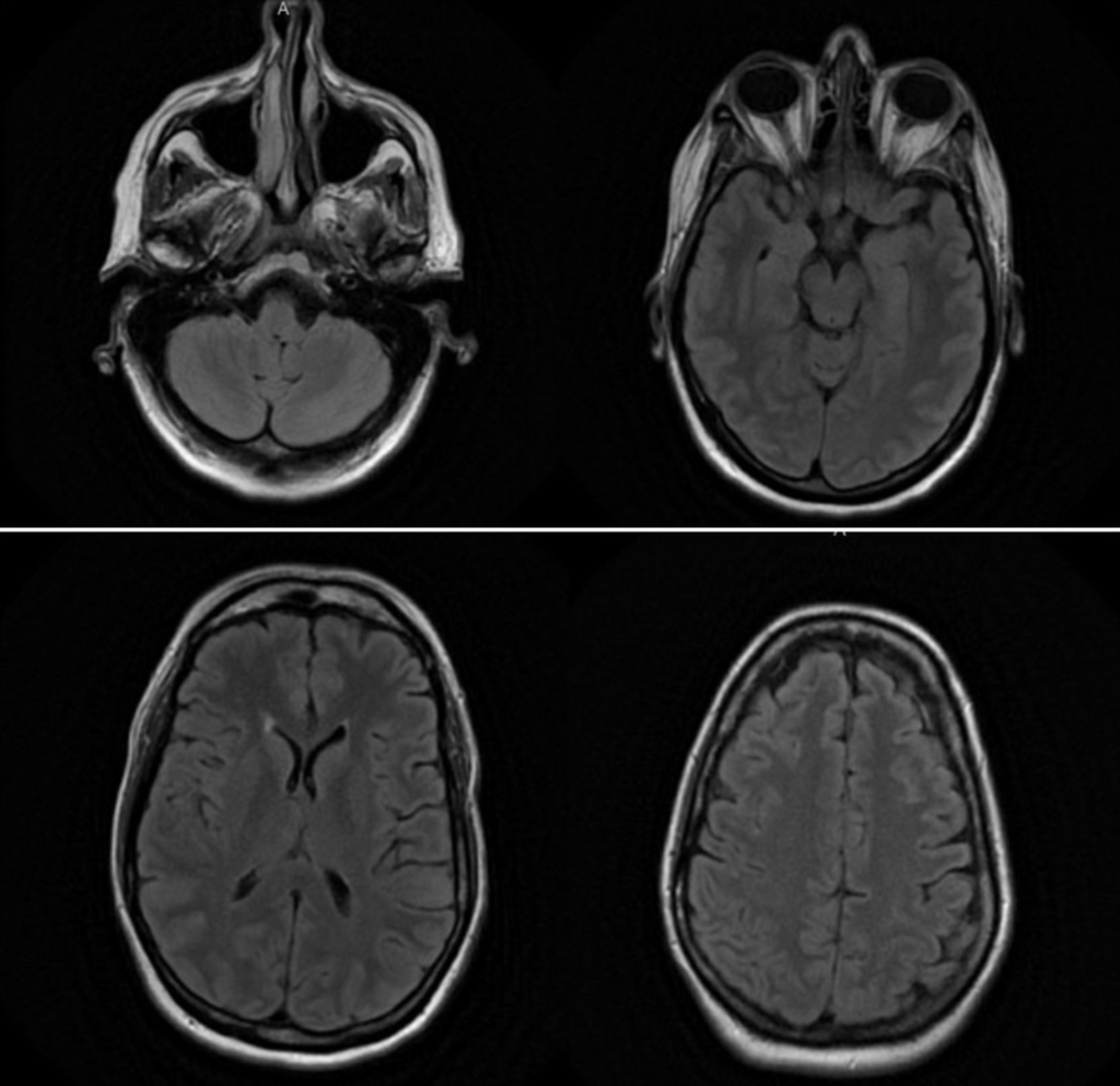 Cureus | Aseptic Meningitis Secondary to Antibiotic Therapy