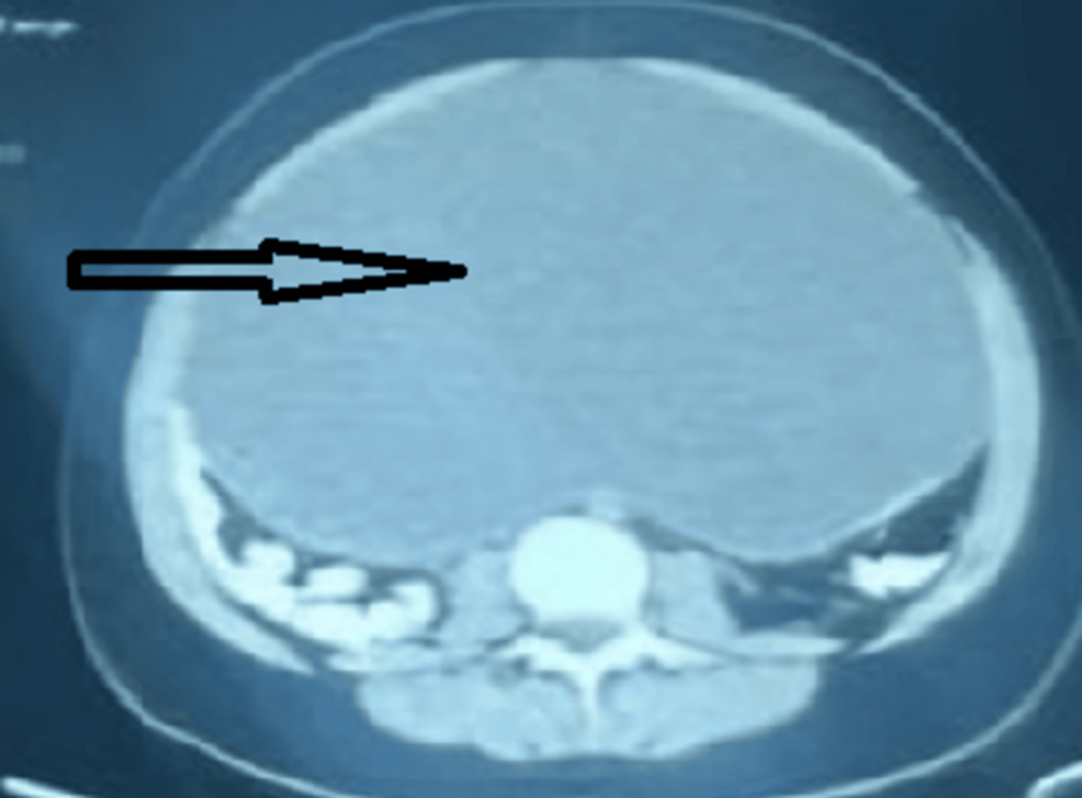 Axial-CT-scan-of-the-abdomen-and-pelvis-without-contrast-showing-an-intracavitary-mass-occupying-the-entire-pelvis-and-part-o