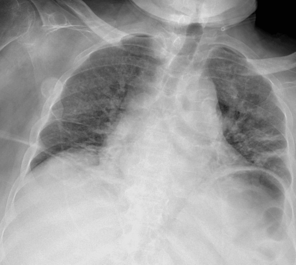 Octreotide Efficacy in Treating Refractory Intradialytic Hypotension: A Case Report