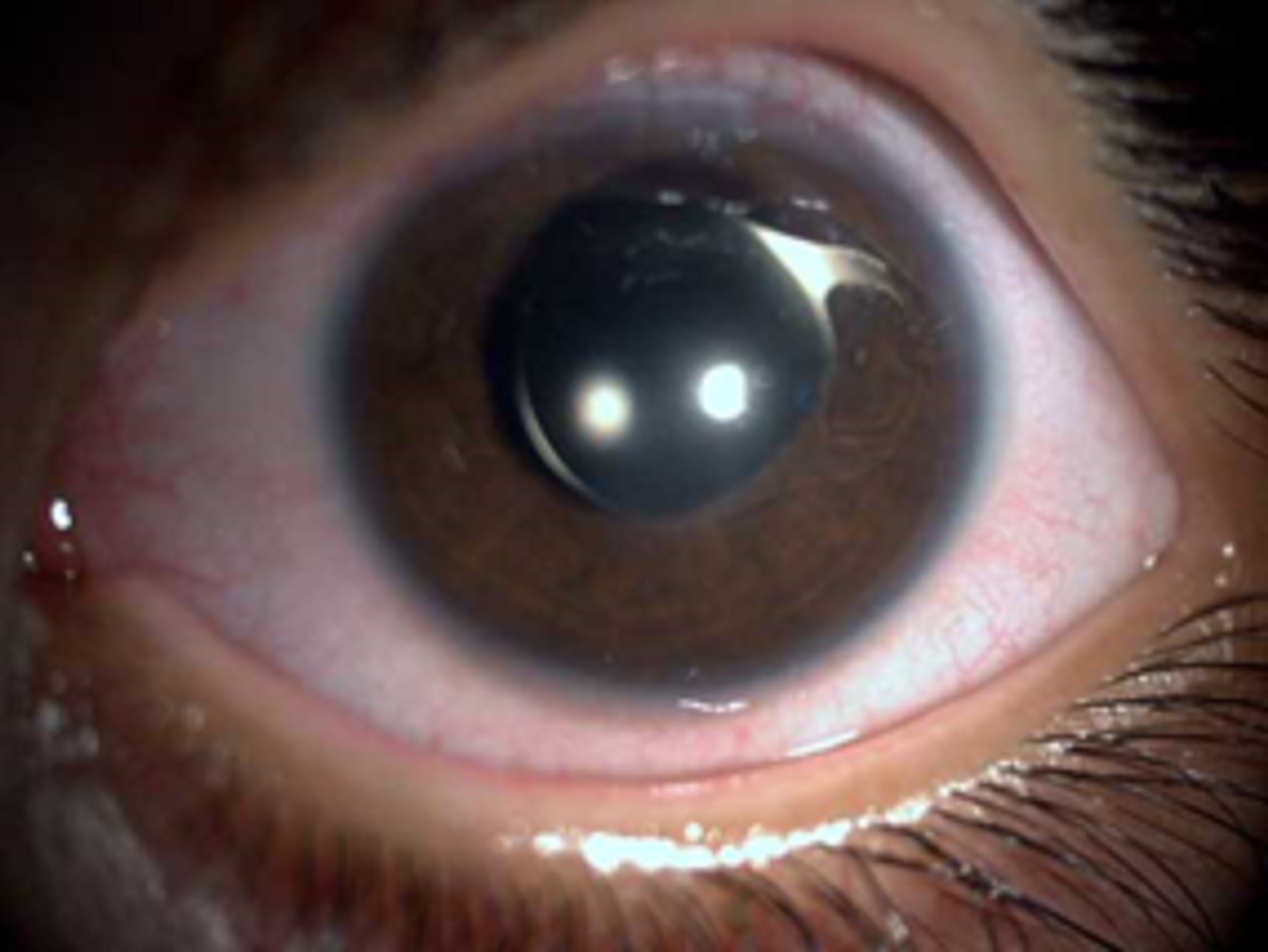 Boos worden Voel me slecht Methode Cureus | Unilateral and Spontaneous Complete Anterior Dislocation of the  Crystalline Lens in a Patient With Homocystinuria | Article