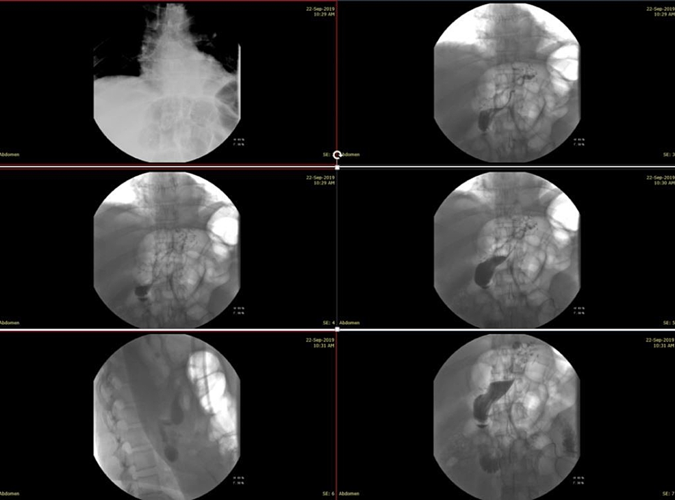Cureus Delayed PostLaparoscopic Sleeve Gastrectomy Leak Successfully