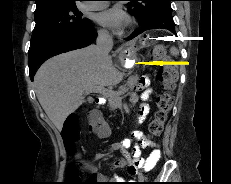 Cureus Delayed PostLaparoscopic Sleeve Gastrectomy Leak Successfully