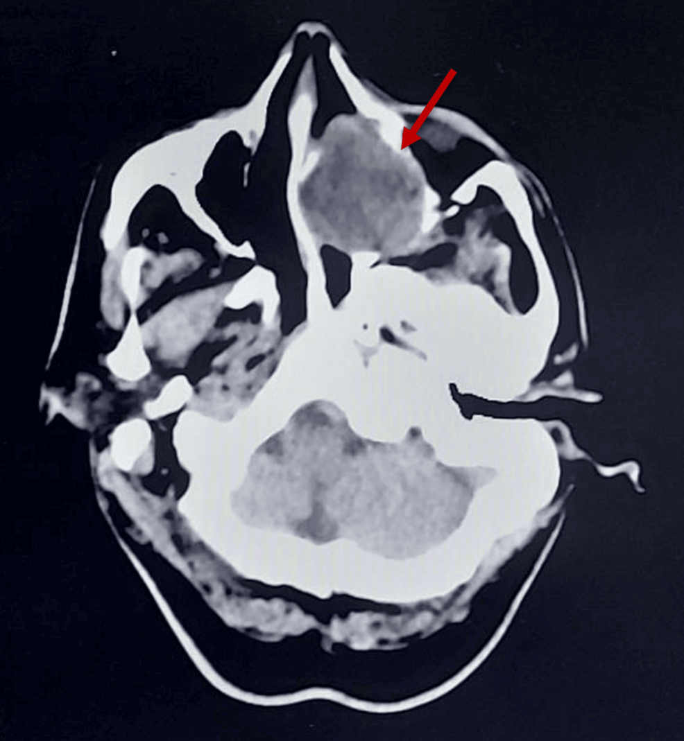 Generalized Tetanus in an Unvaccinated 52-Year-Old Male Gardener: Diagnostic and Therapeutic Challenges in a Low-Resource Setting