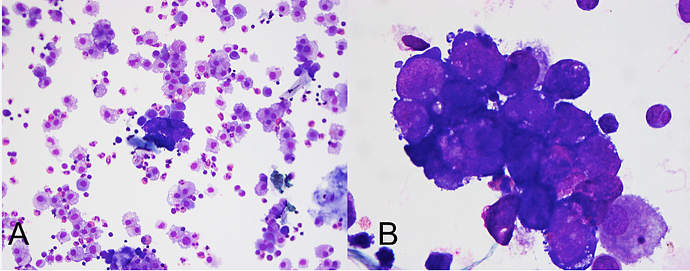 Wright-Giemsa-stained-cytospin-preparation-of-pleural-fluid-specimen-at-(A)-200x-and-(B)-1000x-total-magnification
