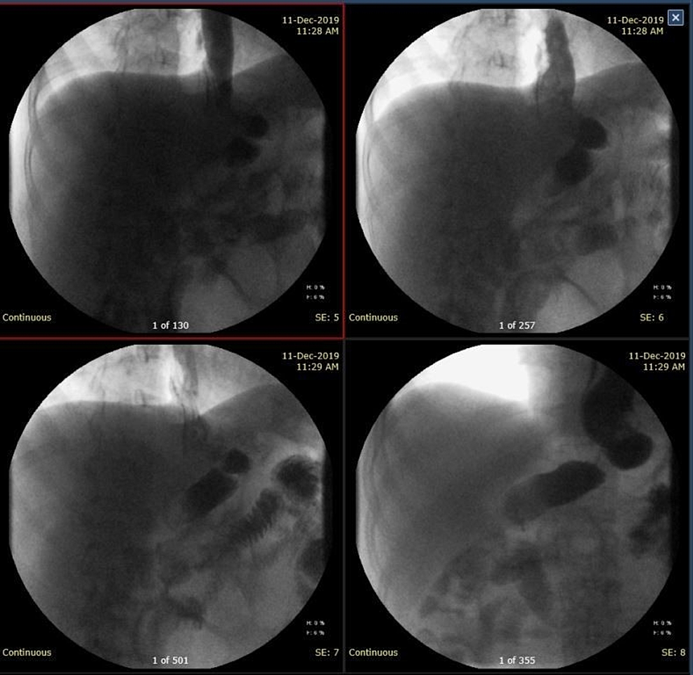 Cureus Delayed PostLaparoscopic Sleeve Gastrectomy Leak Successfully