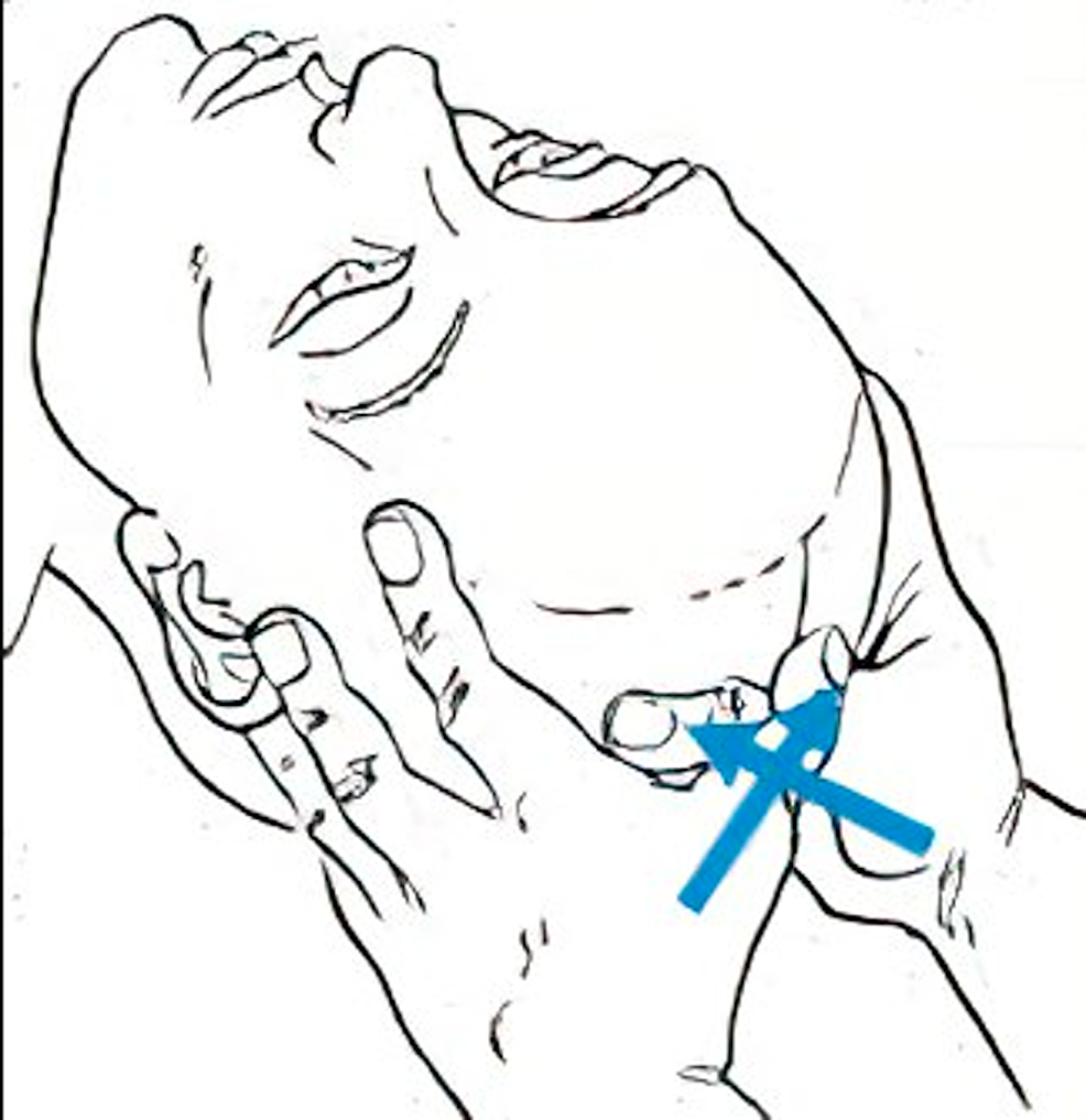 Venous-sinus-drainage-at-the-proximal-superior-sagittal-sinus
