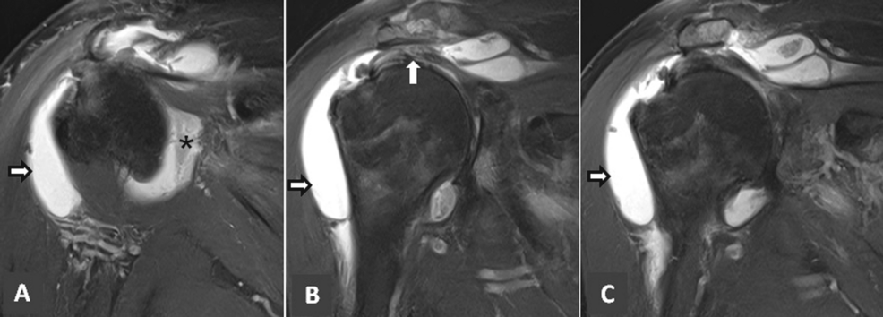 Association of Intra-articular Ozone/Prolozone Injections With