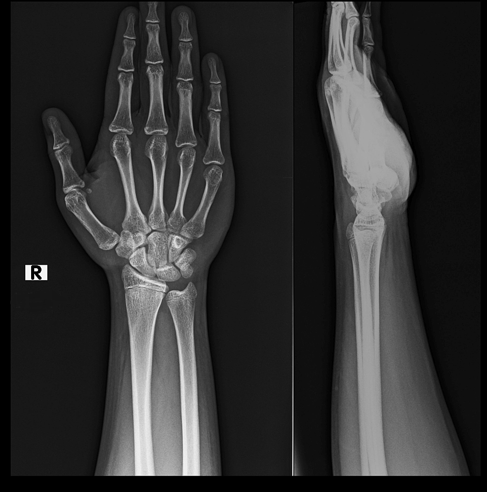 Cureus | A Rare Case of Isolated Type III Salter-Harris Physeal Injury ...