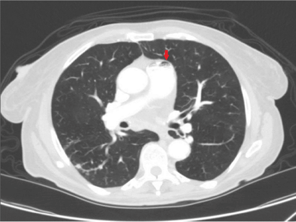 Silent Air Embolism Linked to IV Drug Use Found Incidentally