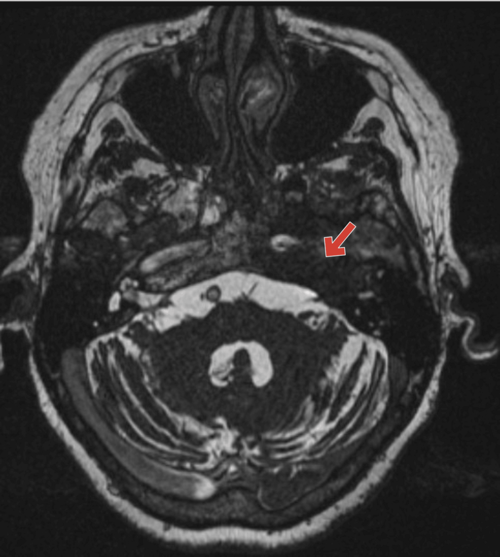 Identification of a Hidden Lesion in Meckel's Cave: A Diagnostic Odyssey of Unilateral Facial Pain in a Nonagenarian