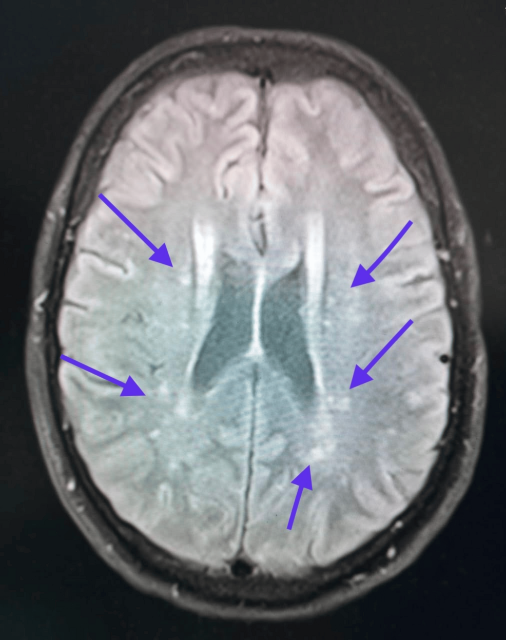 Functional Recovery Following Post-vaccination Neurological