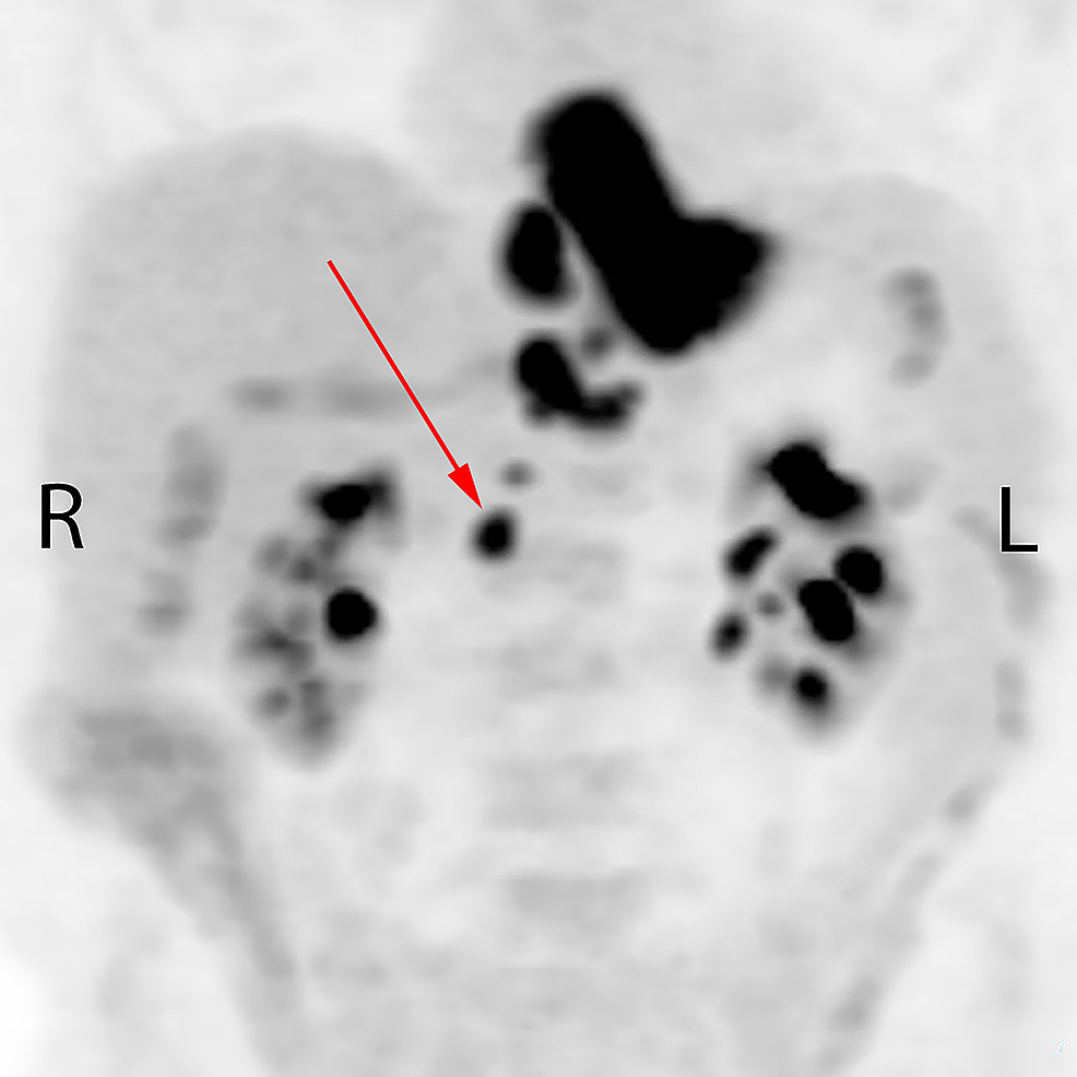 Pre-treatment-staging-positron-emission-tomography-showing-primary-tumor-and-nodal-disease-involving-the-paraesophageal-regions-and-upper-abdomen-extending-to-the-level-of-the-right-renal-vessels.-The-red-arrow-indicates-the-untreated-node.