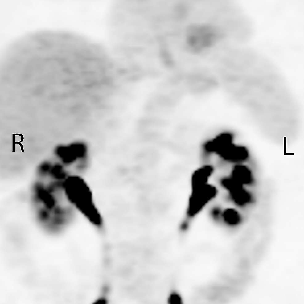 Post-treatment-positron-emission-tomography-showing-resolution-of-all-primary-tumor-and-nodal-disease,-including-nodes-outside-the-radiation-treatment-volume.