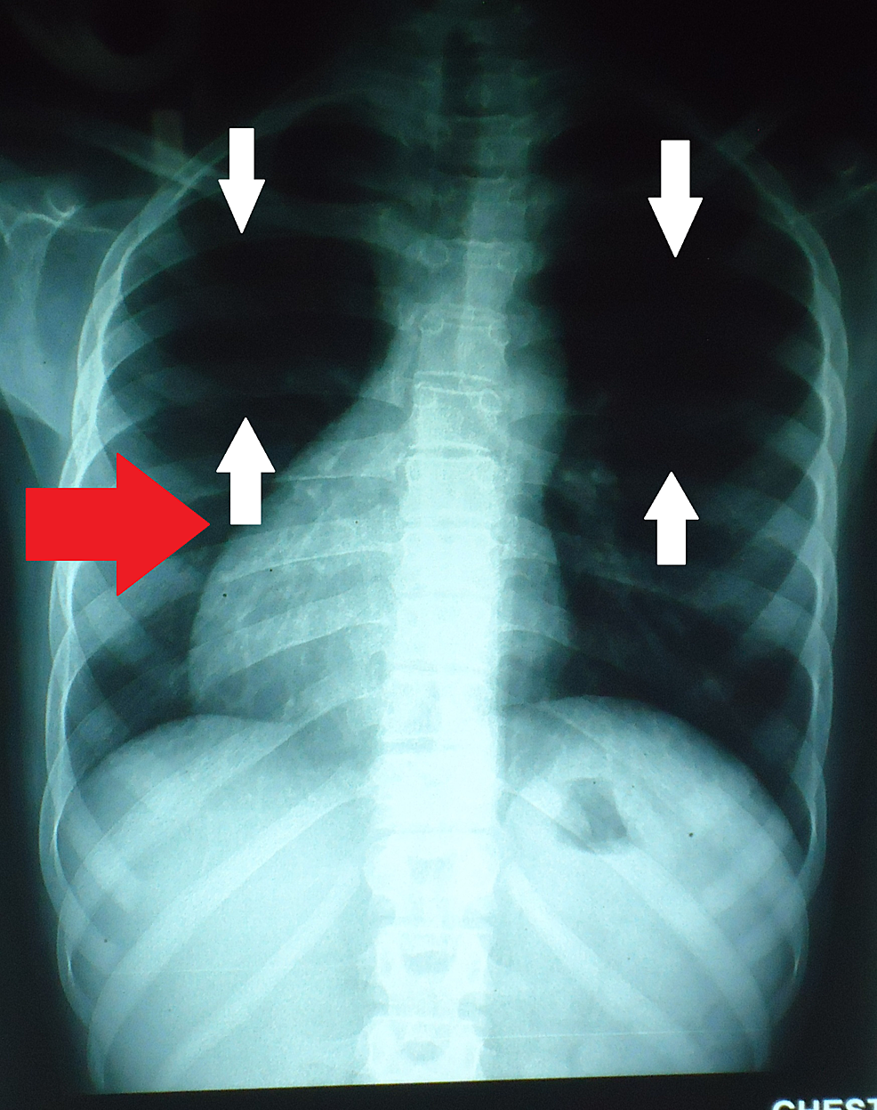 Posteroanterior-chest-X-ray-PA-showing-oligemic-lung-fields-(see-white-arrows).-The-red-arrow-indicates-dextrocardia