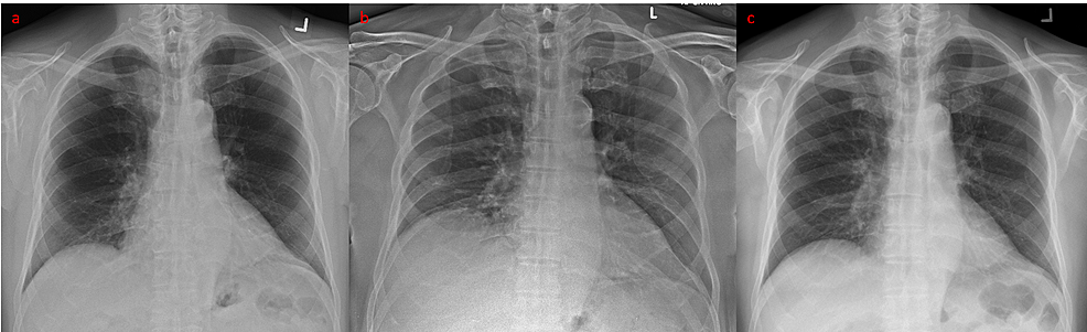 Cureus | Elevated Right Hemidiaphragm: A Clue in Acute Cholecystitis?