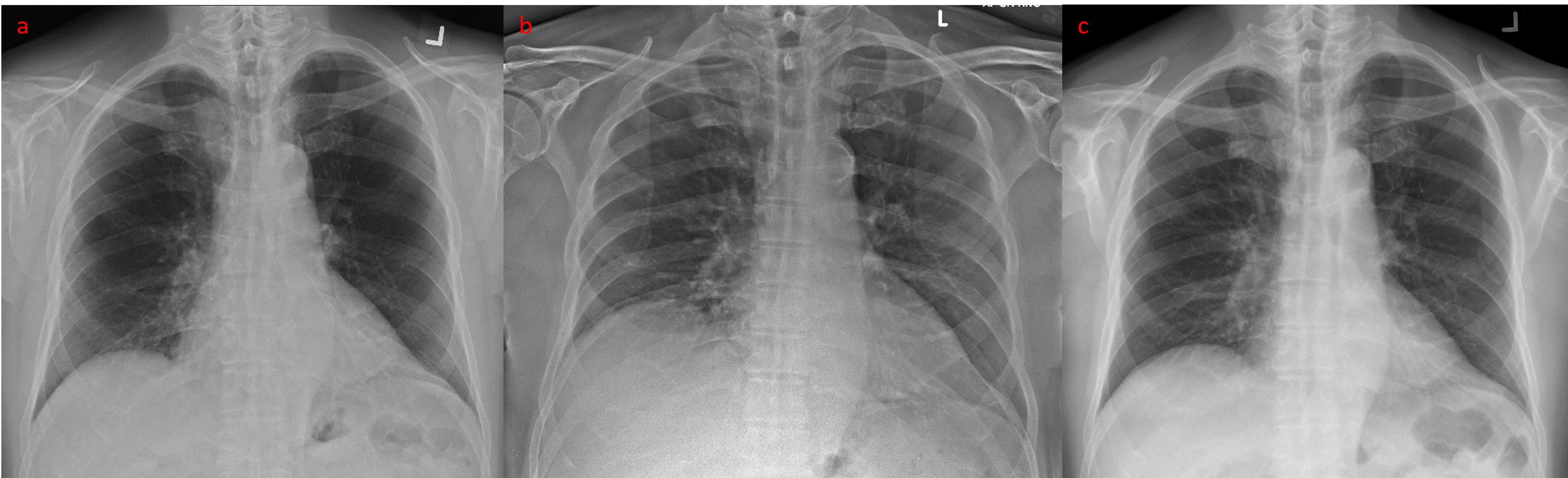 Cureus | Elevated Right Hemidiaphragm: A Clue in Acute Cholecystitis?