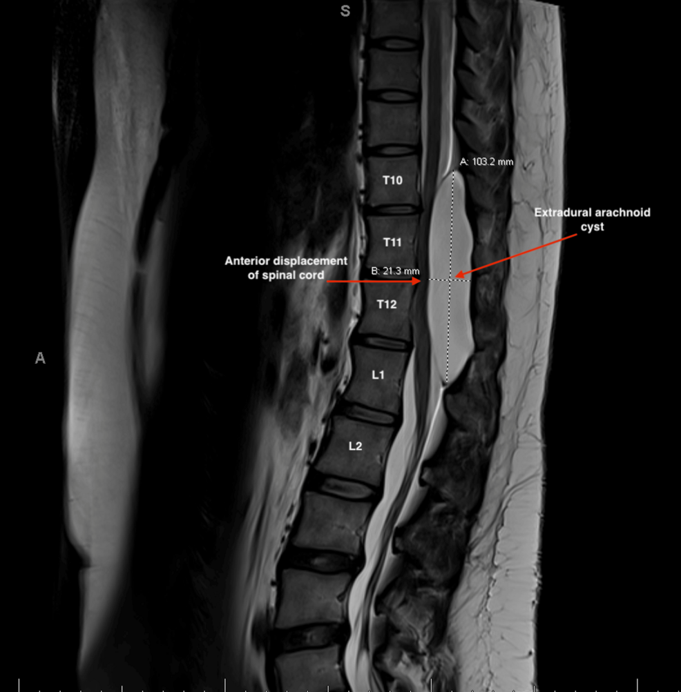 Surgical Treatment of a Large Multiloculated Thoracolumbar Spinal Extradural Arachnoid Cyst: Case Report via Decompressive Laminectomy - News Directory 3