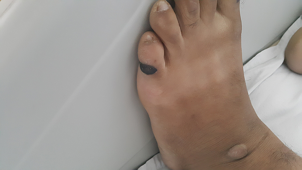 Cureus Compression Stockings and Pressure Ulcers Case Series of a