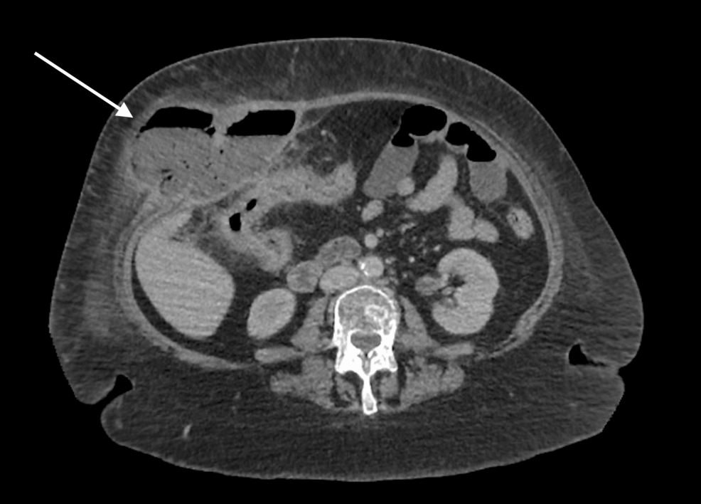 Rare Gastrocolic Fistula in Crohn’s Disease: A Case Report