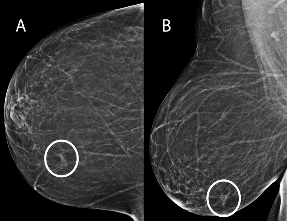 Understanding Metaplastic Breast Carcinoma: A Rare Subtype of TNBC
