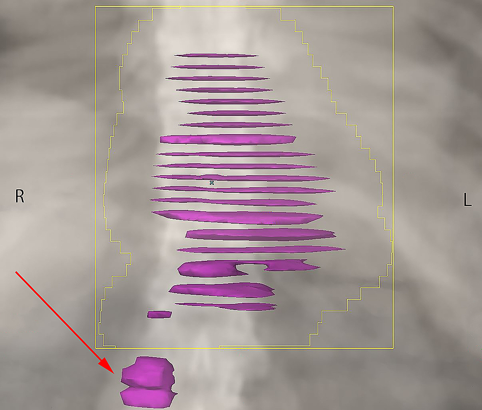 Palliative-radiation-treatment-volume,-targeting-the-primary-tumor-and-paraesophageal-nodes-only.-The-red-arrow-indicates-the-untreated-node.