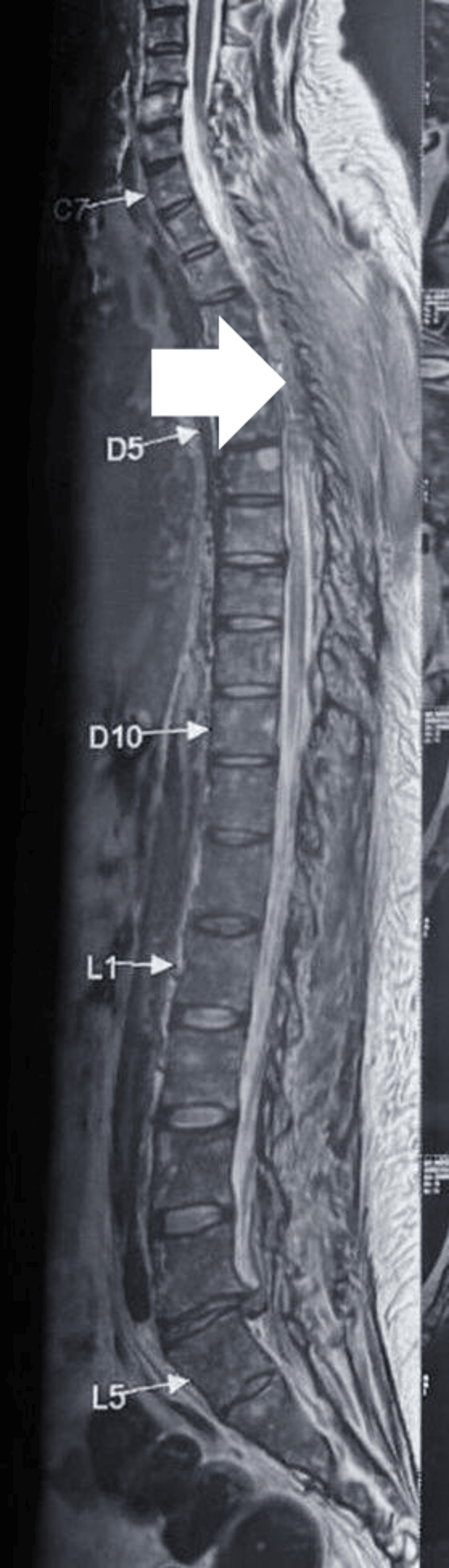 Magnetic-resonance-imaging-of-the-spine-showing-an-epidural-abscess-extending-from-C7-to-D6.-Arrow-indicating-epidural-abscess.