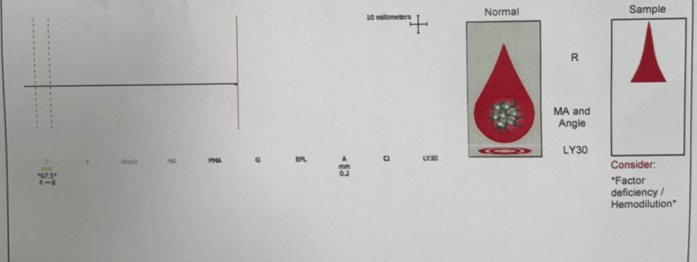 Intraoperative-thromboelastography-showing-a-flatline-tracing-with-no-measurable-clot-formation