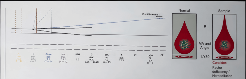 Thromboelastography-showing-an-R-time-of-22.3-minutes