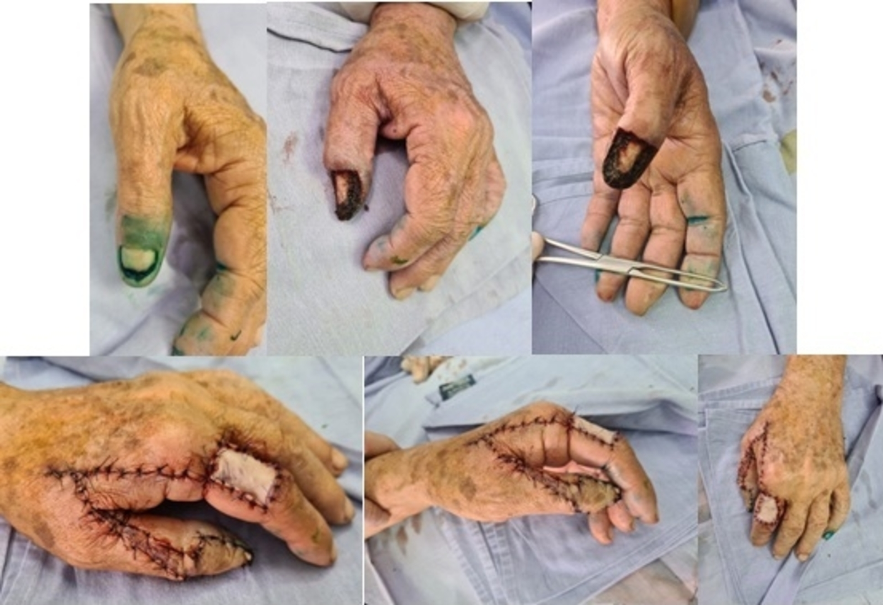 Cureus | Squamous Cell Carcinoma of the Nail, an Underdiagnosed and Underestimated Entity: A Series of Two Cases | Article Cureus | Squamous Cell Carcinoma of the Nail, an Underdiagnosed and Underestimated Entity: A Series of Two Cases | Article