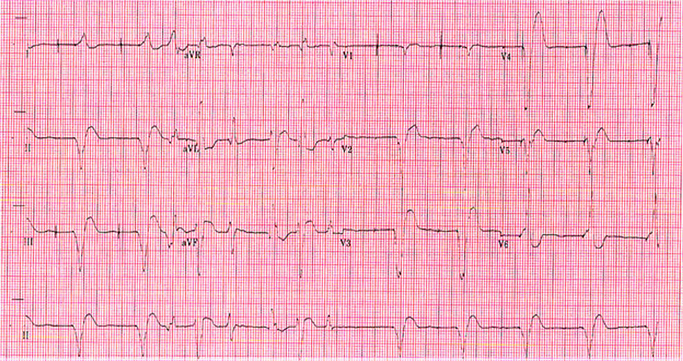 A Visual Resolution of Cardiotoxicity A Case Report of DigoxinInduced