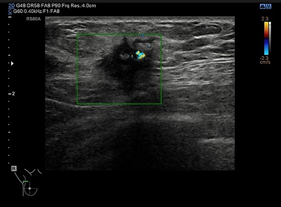 Right-breast-ultrasound-showing-a-25-mm-suspicious-lesion-in-the-right-breast-axillary-tail-(green-square).