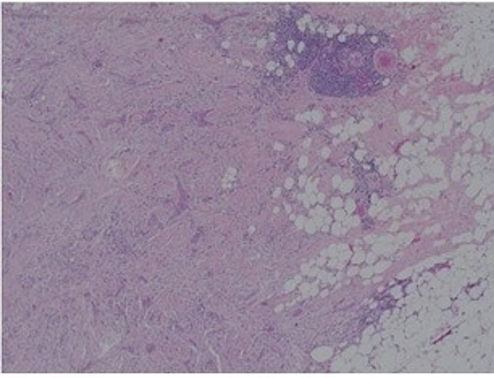H&E-(x10)-sections-of-the-breast-tissue-(after-mastectomy)-showing-irregular-cords-of-carcinoma-in-densely-fibrotic-stromal-background.