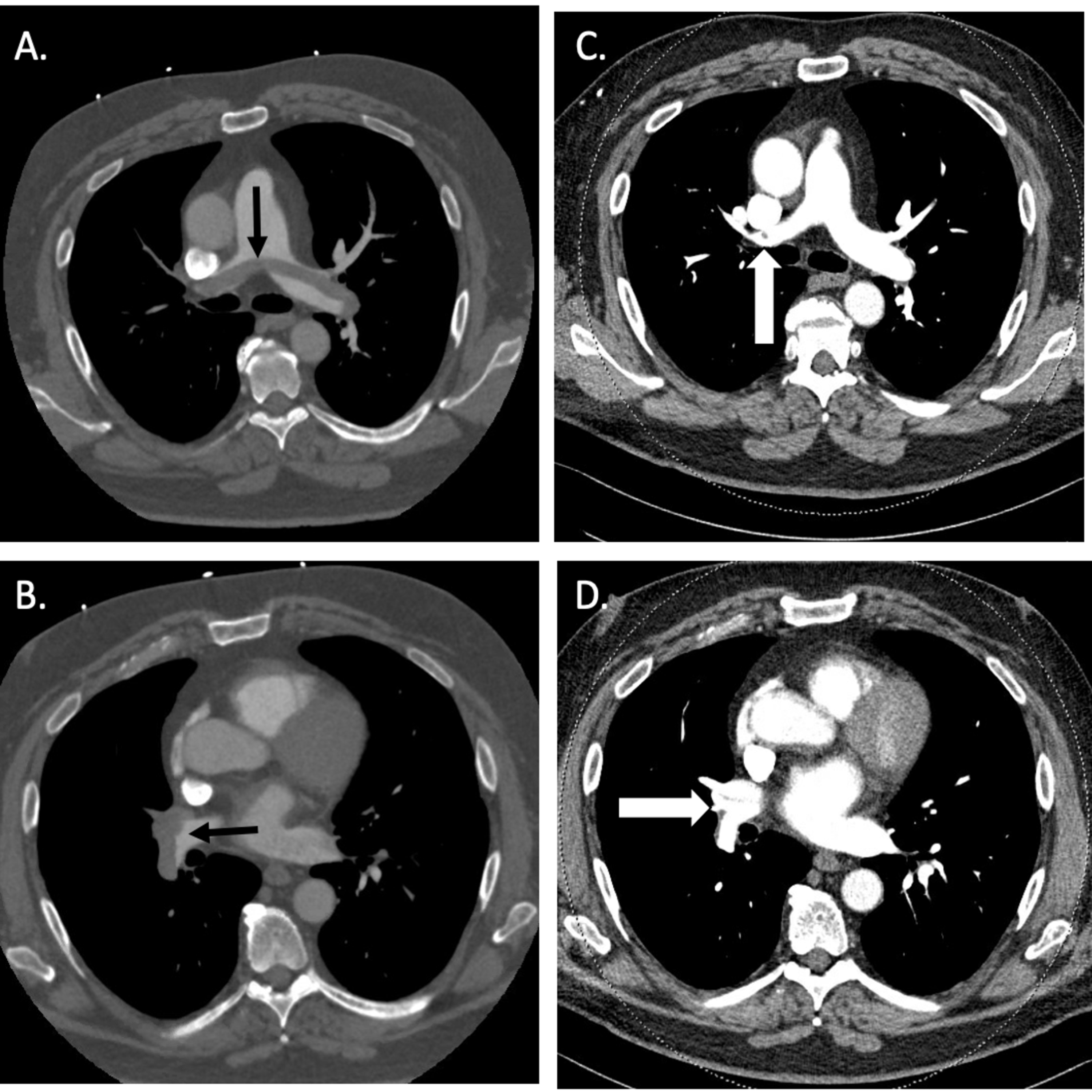 Cureus | Bilateral Pulmonary Emboli and Deep Venous Thrombi in ...