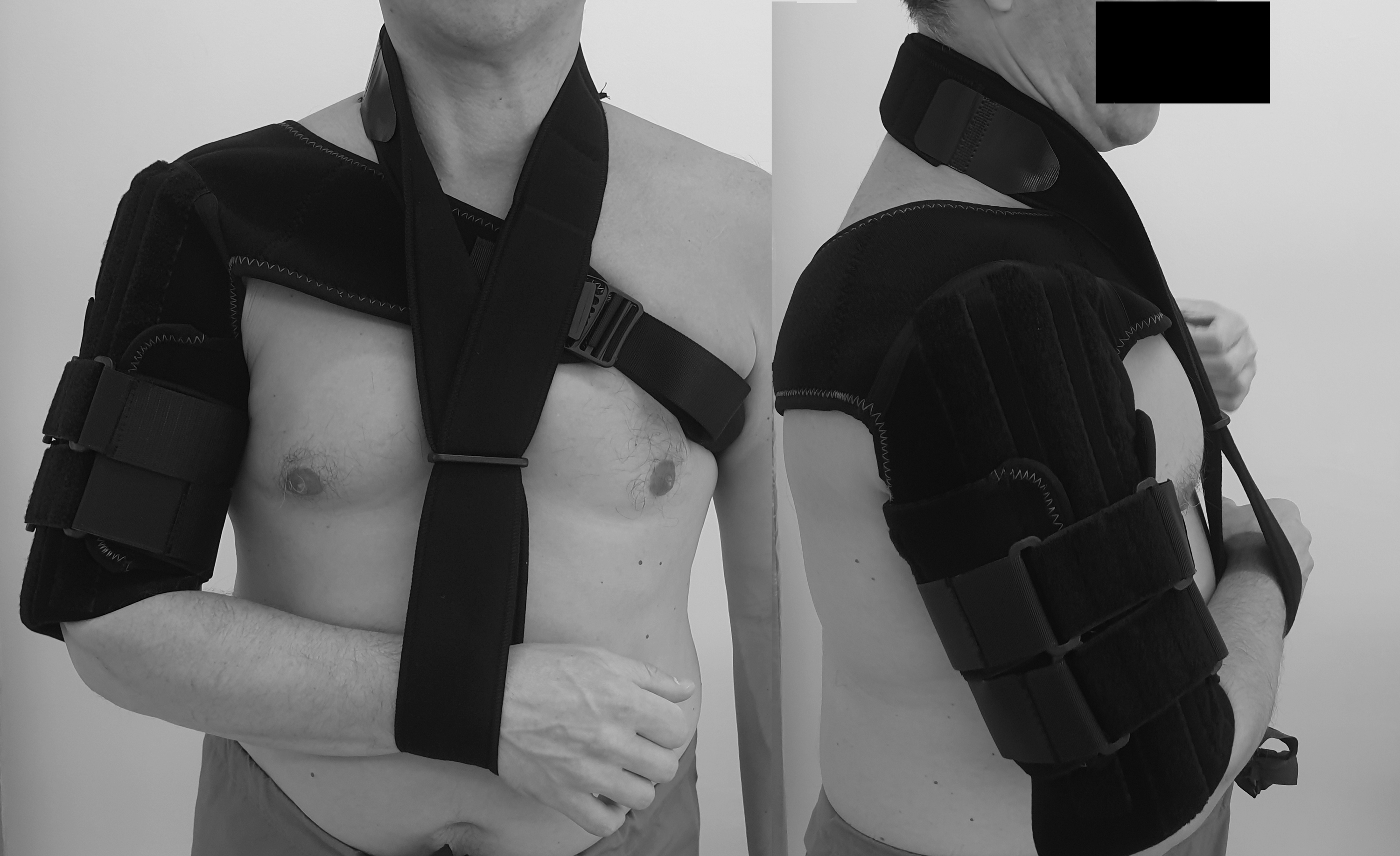 Cureus Treatment of Midshaft Humerus Fractures Using Early Functional