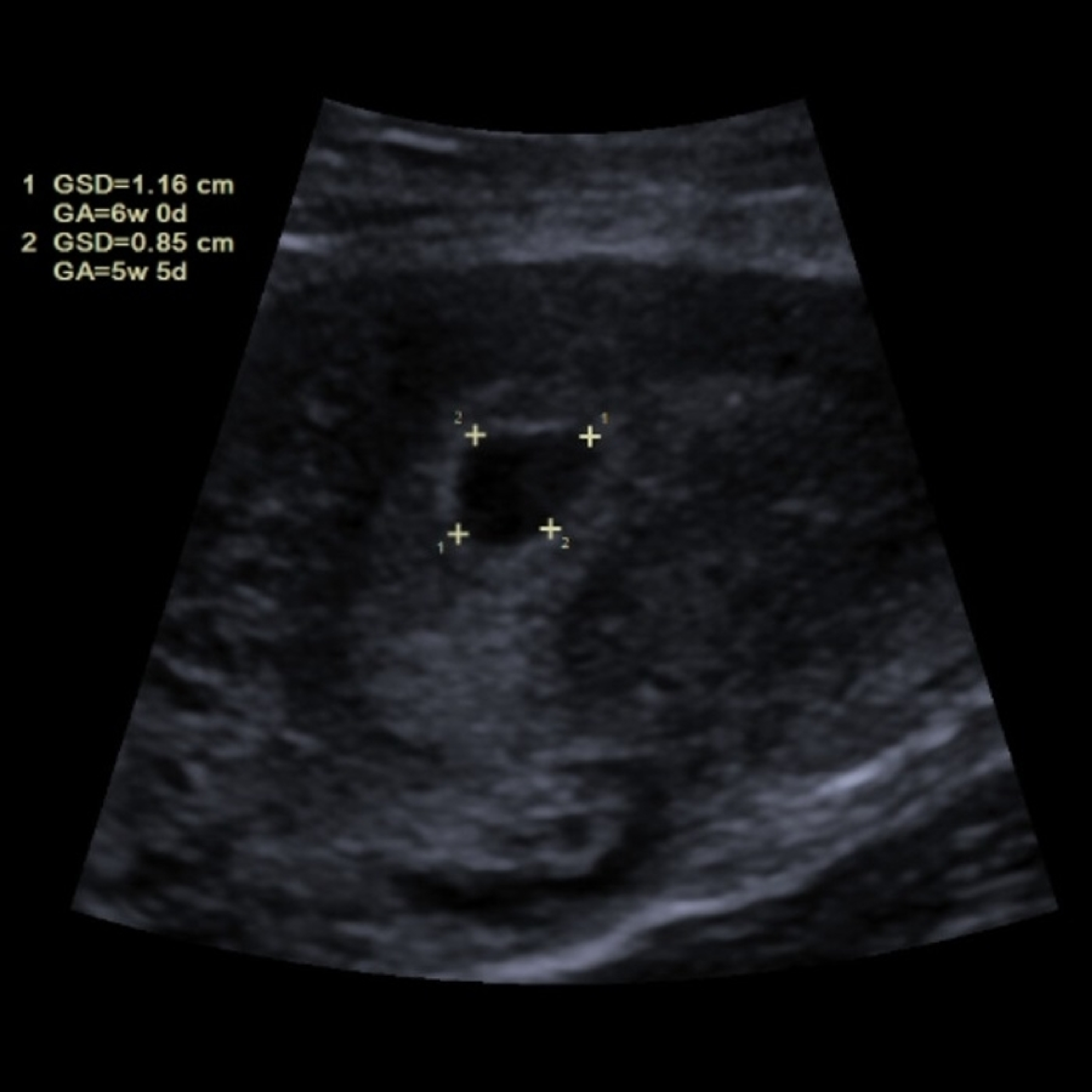 Cureus | Denial of Pregnancy in a Patient With a History of Pseudocyesis