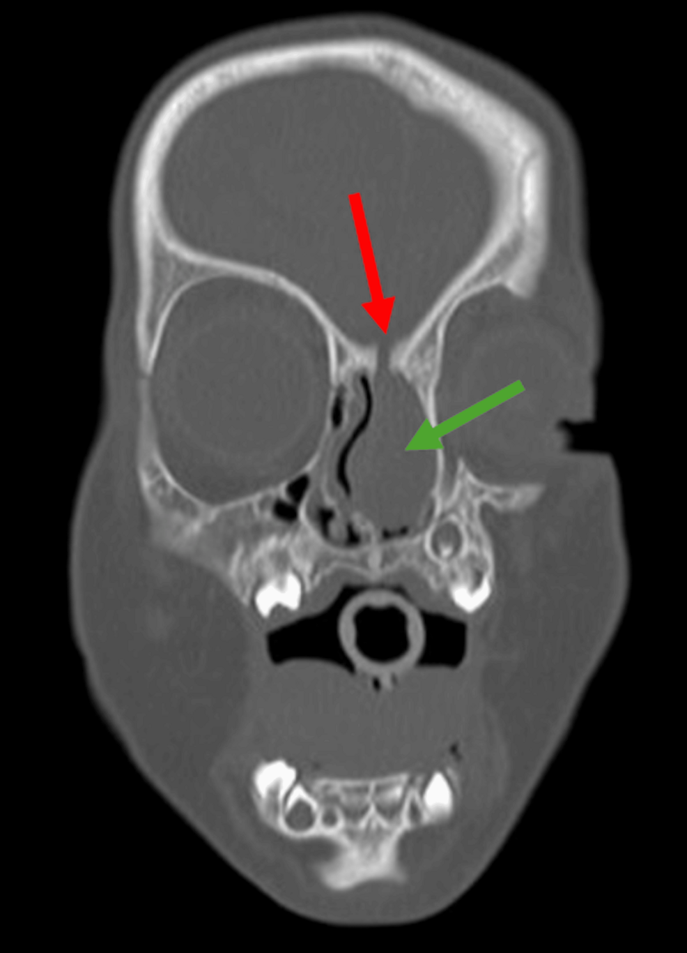 Congenital Nasal Encephalocele Presenting With Pneumococcal Meningitis and Subsequent Bilateral Sensorineural Hearing Loss: A Case Report of a Pediatric Patient